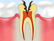 ［画像］C3（象牙質の虫歯）
