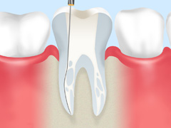［画像］根管治療で抜歯のリスクを減らします